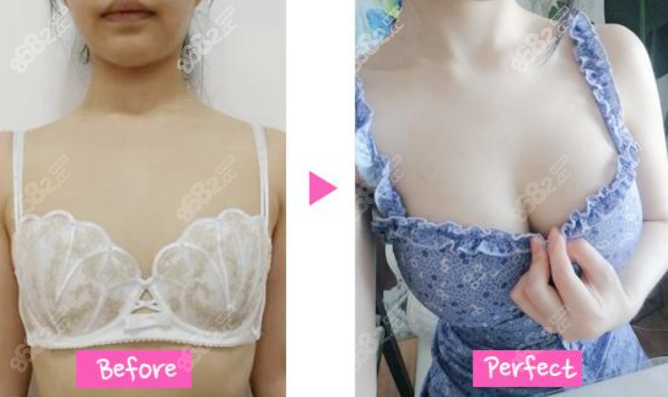 郑在皓院长假体隆胸前后对比图8682.cc