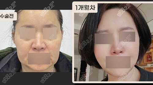 韩国珠儿丽拉皮手术前后对比