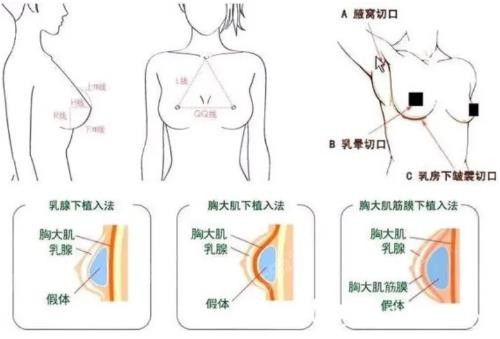 怎样才能丰胸内窥镜图片