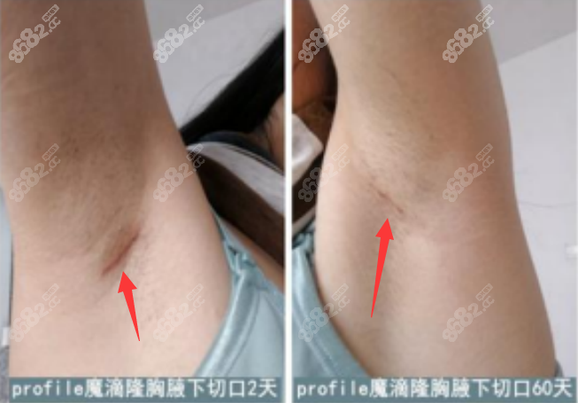 郑在皓院长假体隆胸术后切口不明显