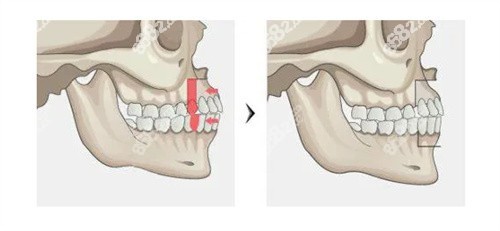 凸嘴做正颌手术前后对比照片