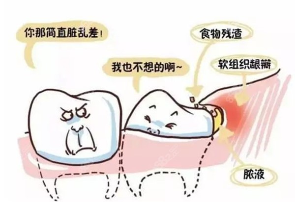 大连口腔医院拔智齿多少费用