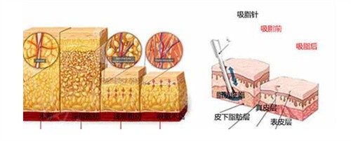 深层吸脂与浅层吸脂结合有助于紧肤平滑