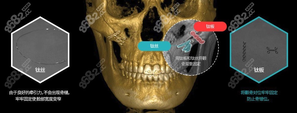 TS整形医院双重固定颧骨缩小术优势