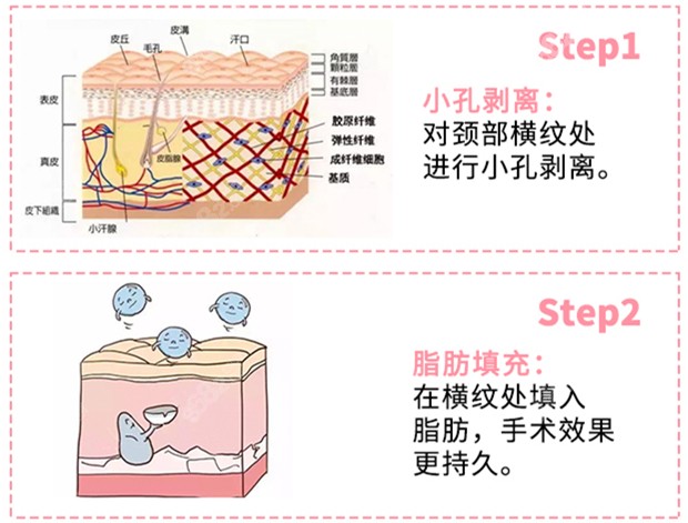 去颈纹技术优势分析