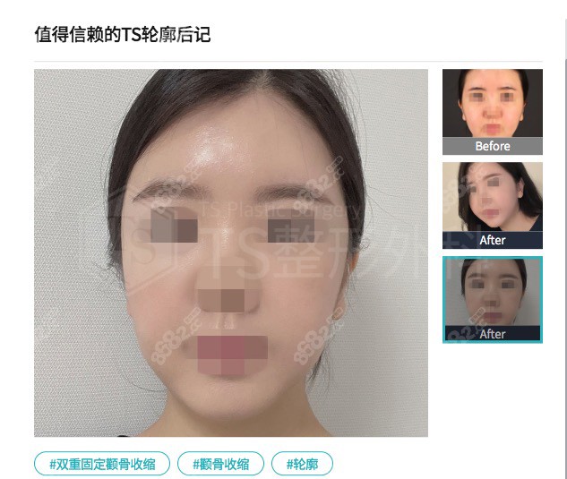 TS整形医院双重固定颧骨缩小术手术手术术后图