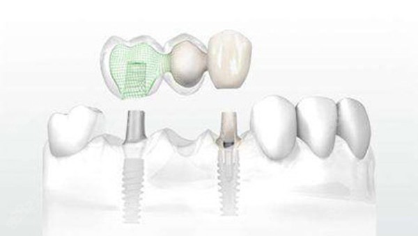 种植牙搭桥图片图片