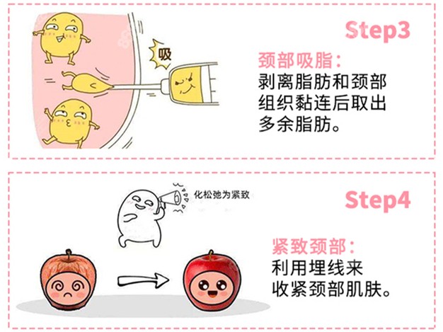 延世多仁的颈纹手术技术图解