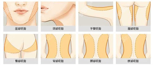 吸脂部位图解