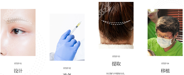 韩国布莱克做眉毛移植的处置和经过