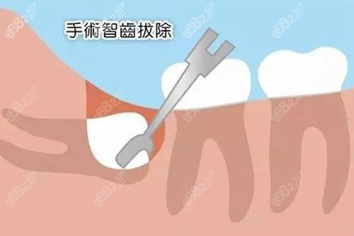 秦皇岛索菲亚口腔拔智齿价格在300-1500元左右不等