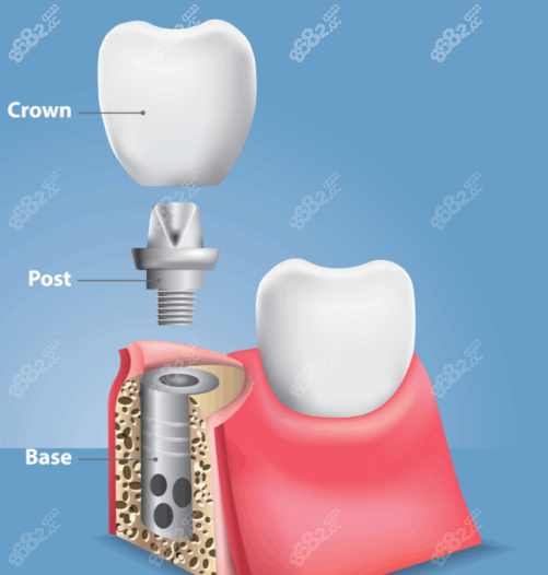 种植牙结构图