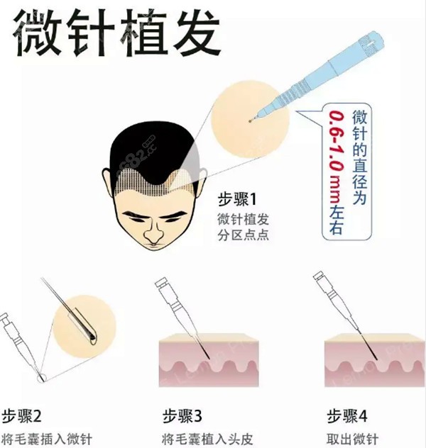 十堰正规植发医院哪家比较好