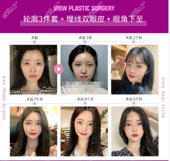韩国必妩整形医院轮廓三件套+双眼皮+眼角下至