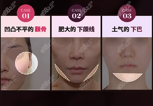 韩国TS医院面部轮廓整形优势