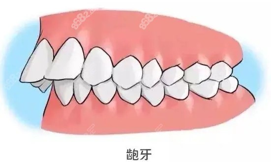 我的牙齿龅牙状态卡通示意图