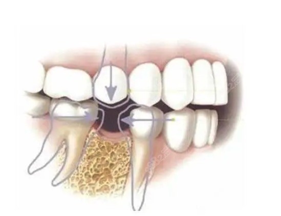 后磨牙缺失有什么影响
