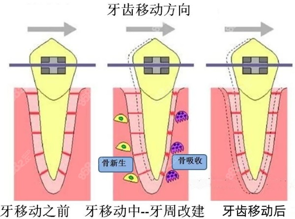 牙齿矫正移动步骤模拟图