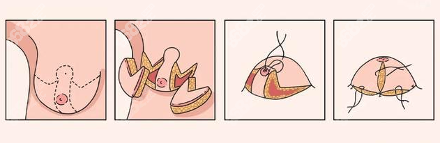 西安正規(guī)乳房縮小手術醫(yī)院排名