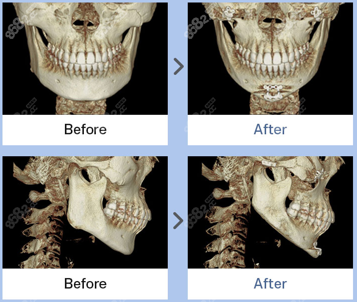 1%整形双鄂整形前后对比图