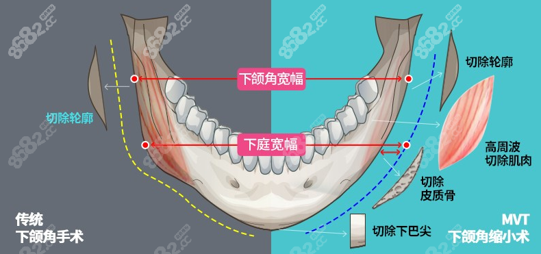 下颌角手术示意图8682.cc