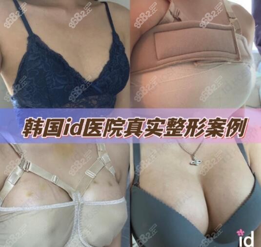 韩国id整形医院假体隆胸术前术后