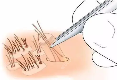 头发整体稀疏细软也能植发