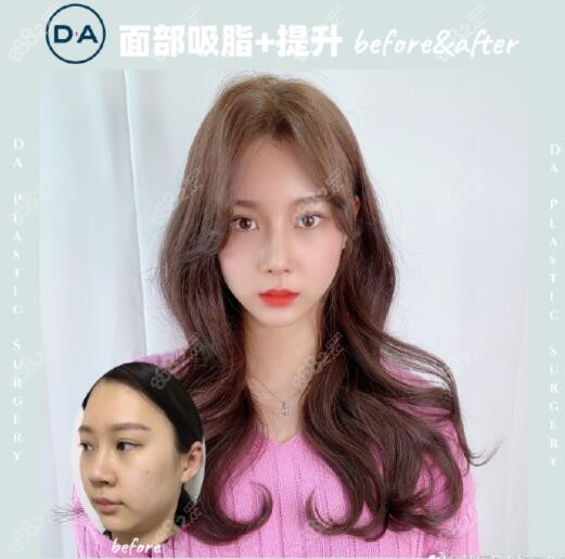 韩国DA整形外科医院面部吸脂+提升项目
