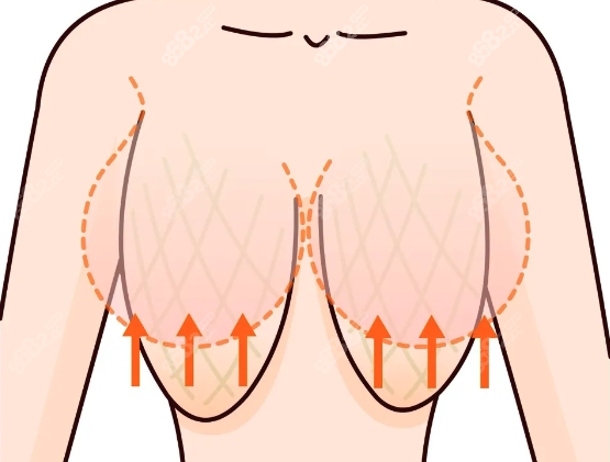 西安乳房縮小醫(yī)院哪家好