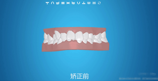 牙齿矫正方案模拟图