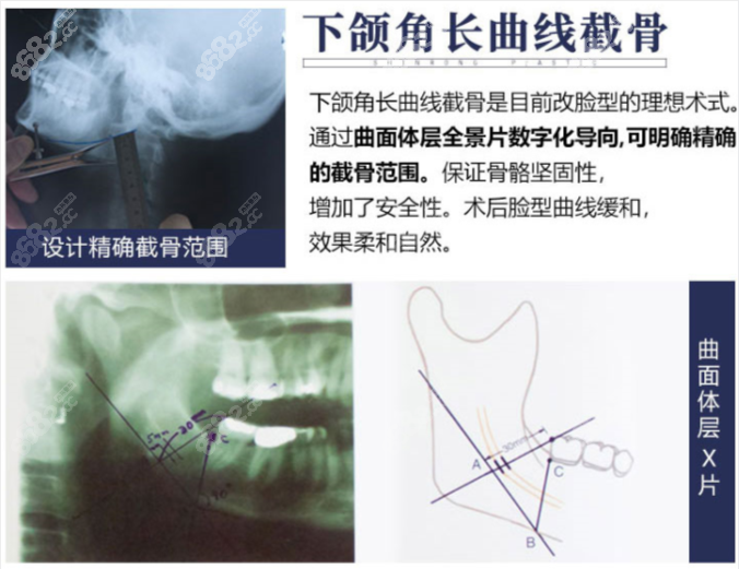重庆当代安可忍下颌角磨骨技术优势