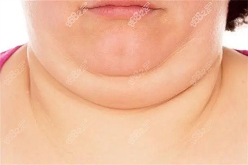 双下巴消除手术中吸脂是非常简单直接的方法