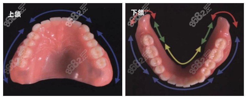 上下半口吸附性义齿示意图