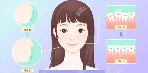 卡通简易版牙齿矫正对比图