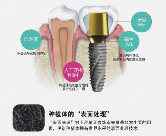 韩国伊诺种植体怎么样