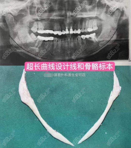 重庆当代安可忍做的下颌角手术怎么样