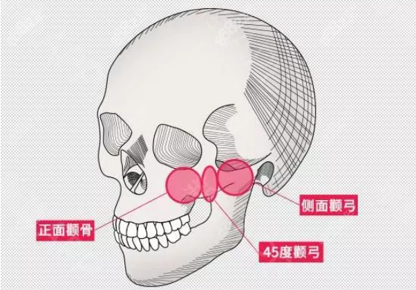 颧骨位置图解