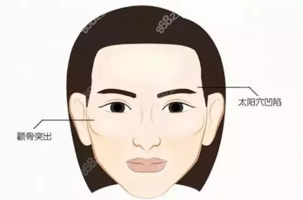 颧骨高太阳穴凹陷整形价格