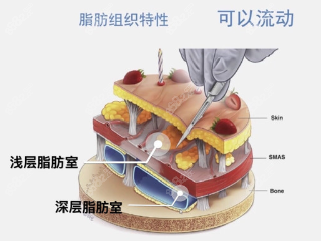 面部脂肪移位提升术