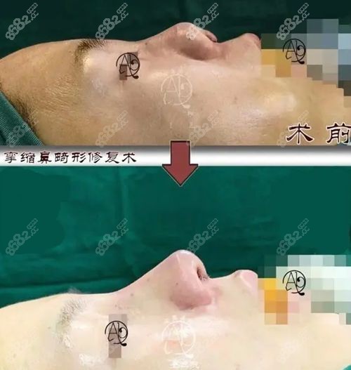 李丙玟高难度鼻修复例子之挛缩鼻修复手术前后对比图www.8682.cc.jpg