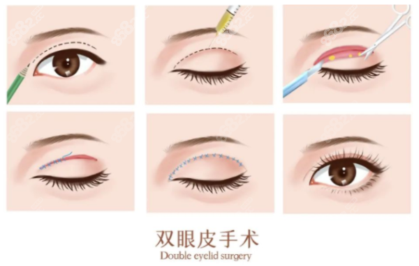 湖州尚麗整形做雙眼皮好嗎8682網(wǎng)
