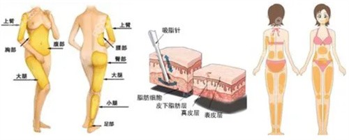 福州海峡孙振东医生做吸脂手术价格多少钱？