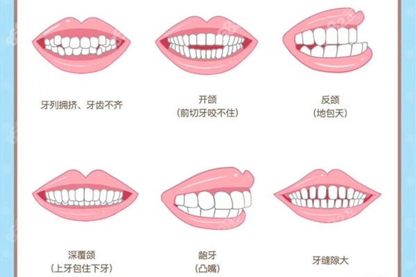 海口牙齿矫正多少钱