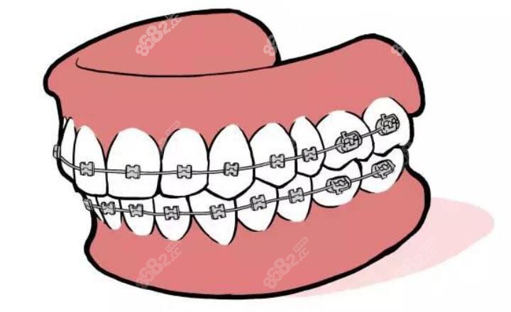 金属牙齿矫正示意图