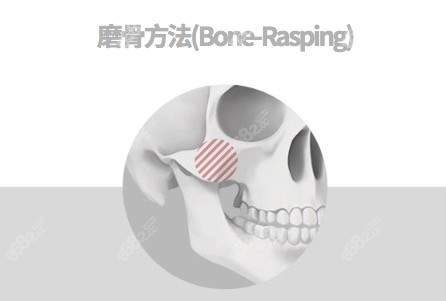 颧骨内推为什么不建议做？我做颧骨颧弓手术5年了真的很香