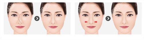 韩国431整形医院歪鼻矫正和蒜头鼻矫正