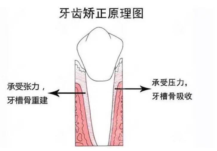 牙齿矫正原理图www.8682.cc