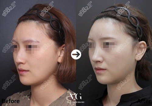 韩国VG百利酷整形医院术例