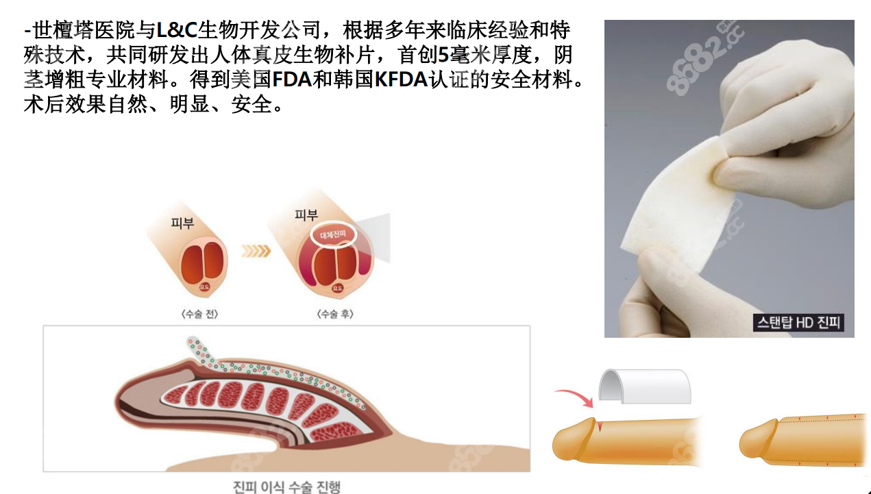 生物补片阴茎增粗怎么做