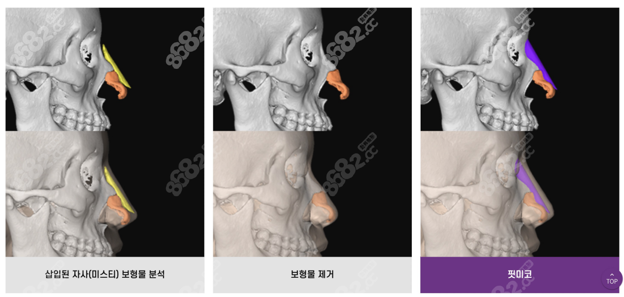 韩国歌柔飞院长有3D打印隆鼻技术